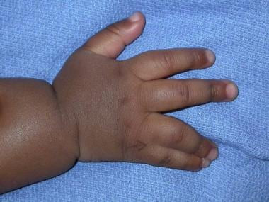 Acrosyndactyly